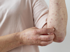 В Роспотребнадзоре прокомментировали возможную вспышку кори в Воронежской области