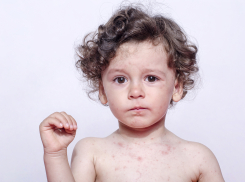 В Бобровском районе 15-летний подросток заболел корью