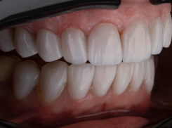 Житель Аннинского района заплатит 228 тыс. рублей за выбитые зубы