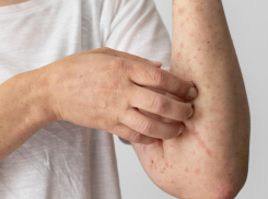 Санврачи рассказали о статистке заболевания ветряной оспой и корью в Воронежской области