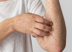 В Воронежской области резко возросла заболеваемость ветрянкой